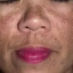 темные пятна на лице женщины